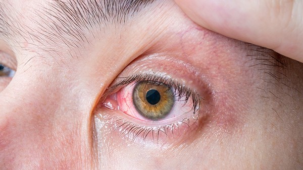 干眼症严重危害健康 诊断标志有哪些