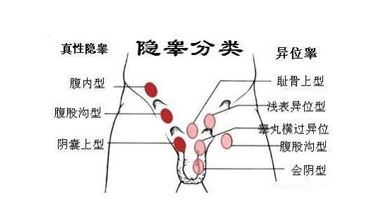 什么是隐睾图片