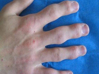 银屑病治疗医院排名_治疗银屑病的药膏图片(3)