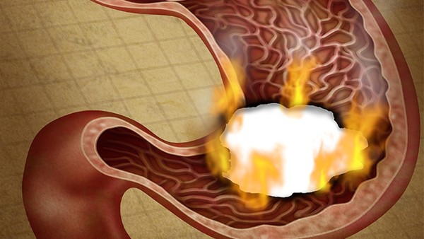 胃溃疡病的特点是什么