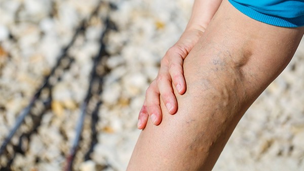 静脉曲张治疗的一些有用方法