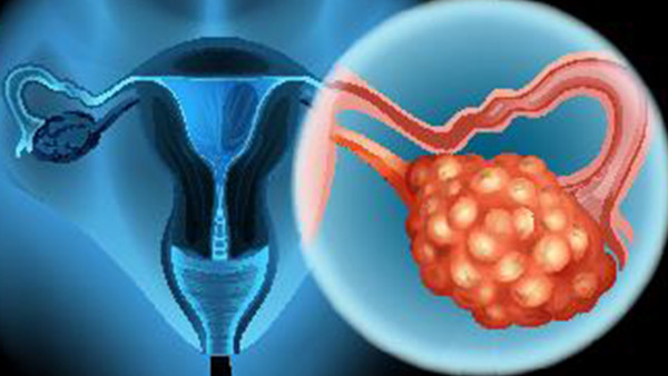 了解卵巢囊肿的预防措施