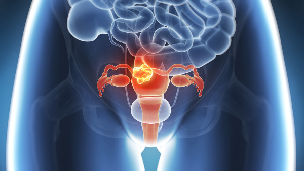 子宫肌瘤的保健常识