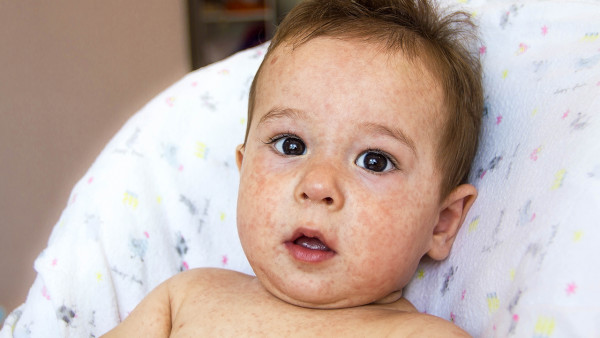 小儿湿疹的危害是什么