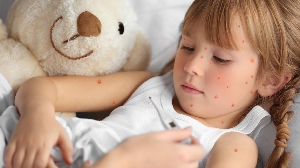 小儿湿疹有什么症状
