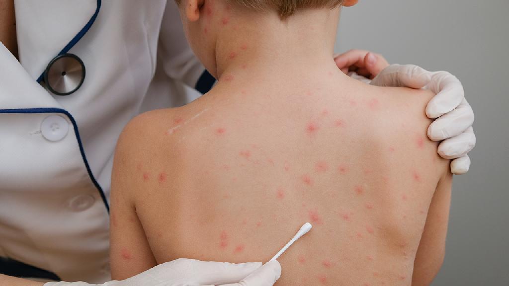 小儿湿疹常见的几种危害有哪些