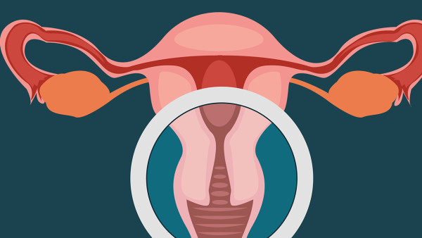 导致多囊卵巢综合征的原因是什么