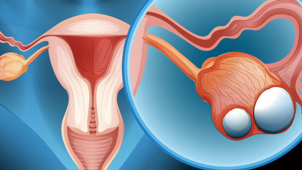 多囊卵巢综合征的治疗方法