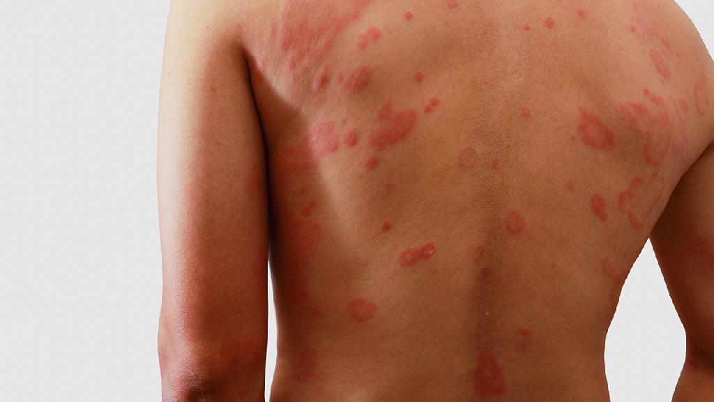 专家讲解湿疹是否是一种遗传病
