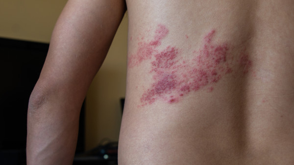 湿疹早期的症状有哪些