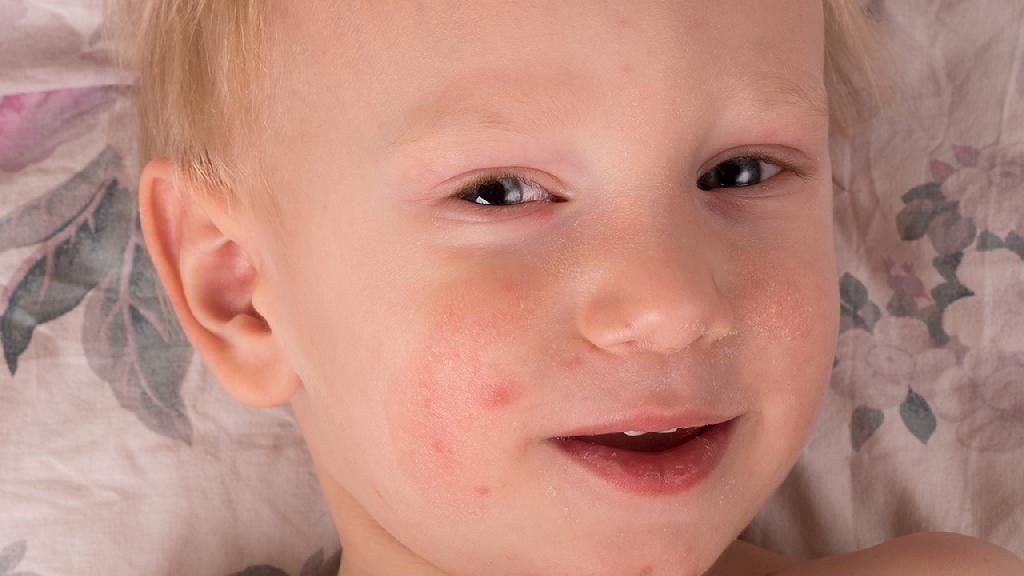 患有荨麻疹能遗传吗