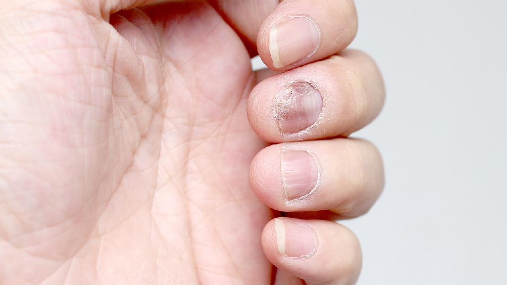 患灰指甲的起因是什么呢