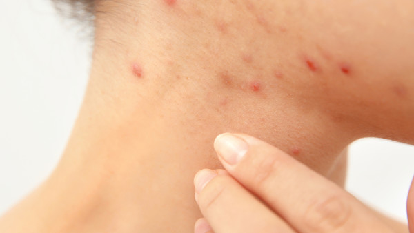皮肤过敏造成的危害严重吗
