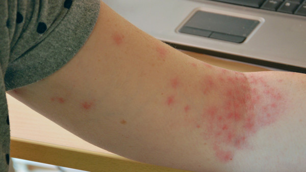 皮肤瘙痒预防措施有哪些