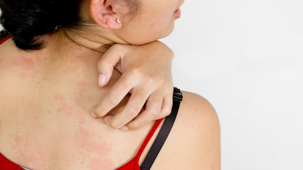 预防皮肤瘙痒应该怎么做