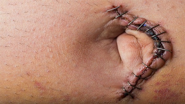 导致疤痕发生的主要因素是什么