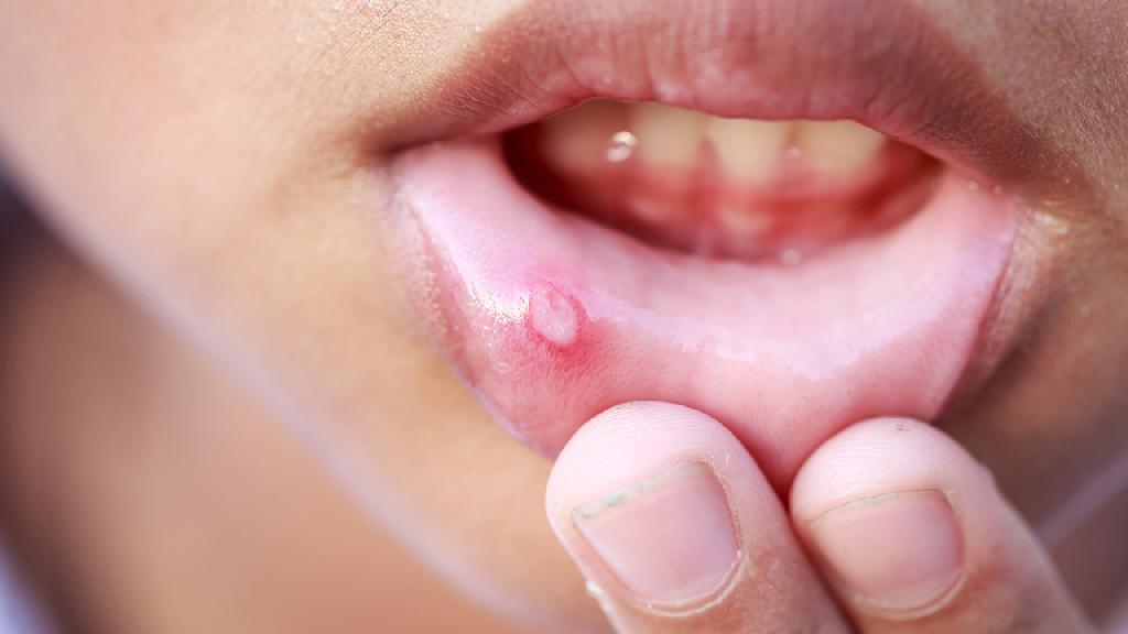 口腔溃疡发作时伴随着哪些症状