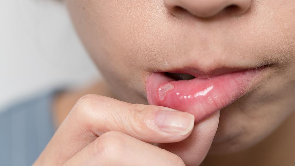对于口腔溃疡的症状您了解多少?