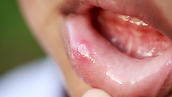 口腔溃疡是否会遗传