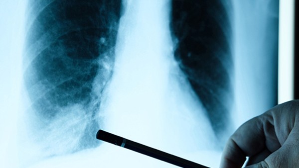肺小细胞肺癌检查方法