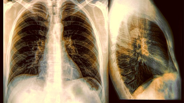 肺癌晚期咳血会传染吗