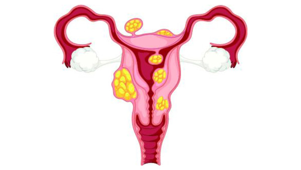 卵巢癌妇科怎么检查