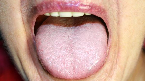 舌癌的危害你了解多少