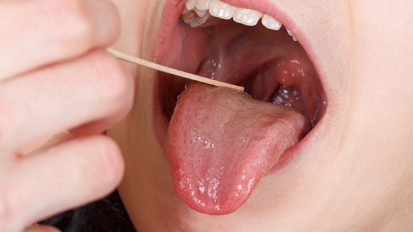舌癌检查费用是多少
