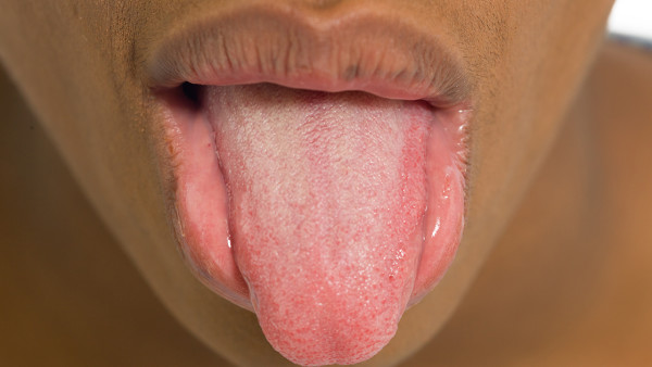 中老年人舌癌会是什么危害