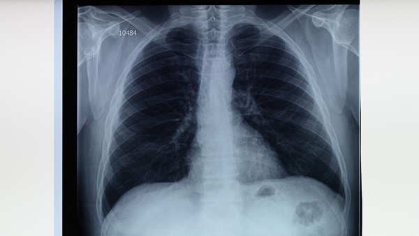 西医治疗肺气肿的费用是多少