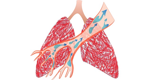 常见肺栓塞有几种