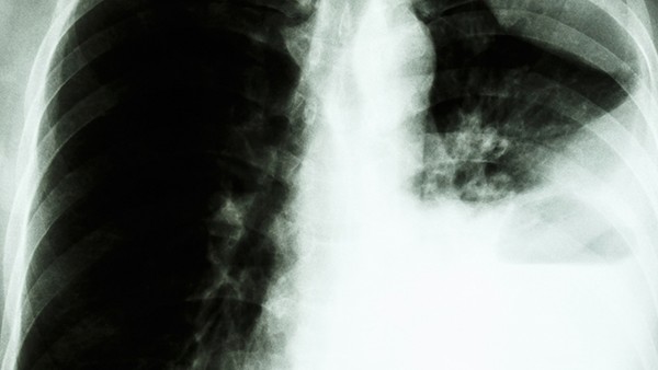 肺结核应该做哪些检查