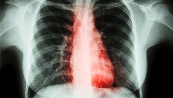 临床肺栓塞的概述