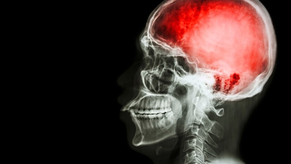 怎么进行脑血管痉挛初步诊断