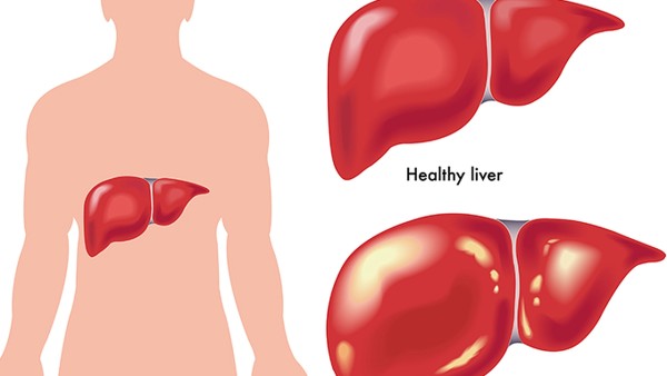 肝血管瘤有哪些典型症状表现