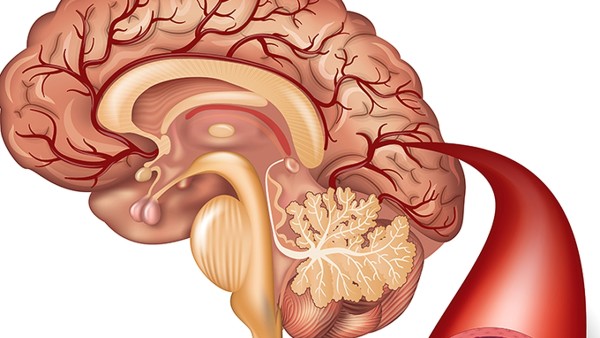 脑血管痉挛有没有后遗症