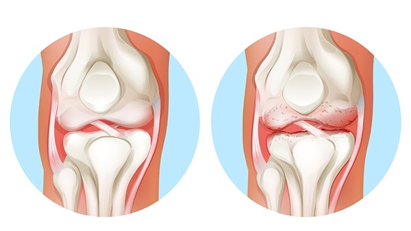 半月板损伤危害有哪些