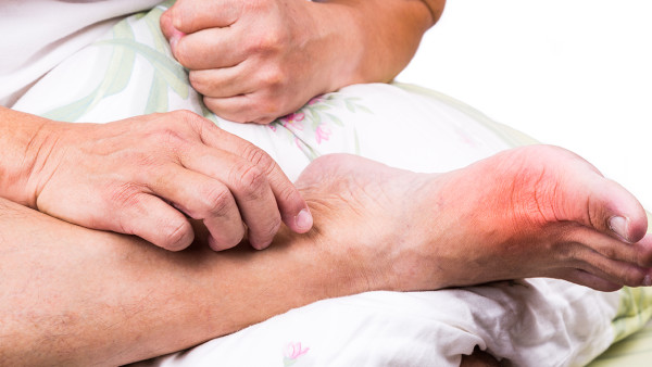 三点重要的坐骨神经痛的饮食注意事项