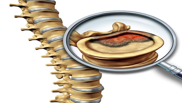 椎管狭窄有什么常识