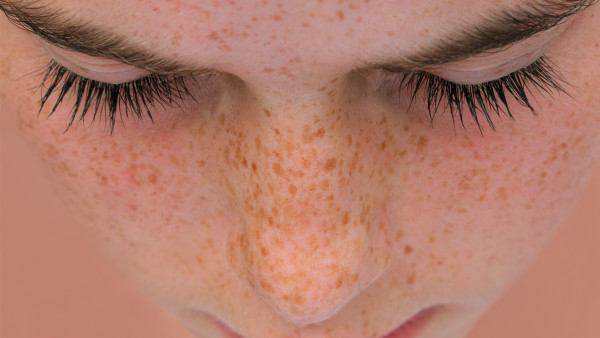 女人脸上各种各样的色斑会传染吗