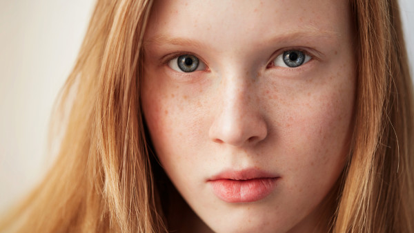 脸上长色斑遗传下一代的机率会大吗