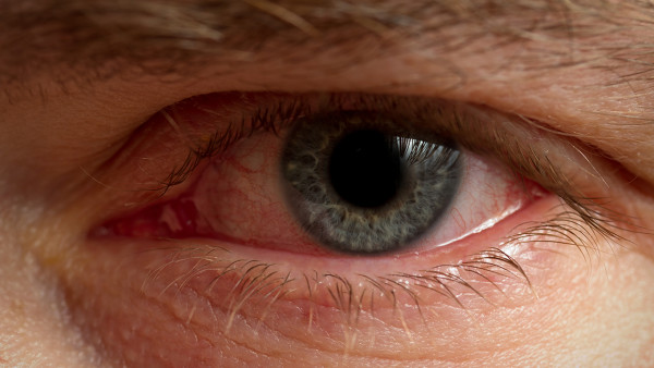 红眼病会因为什么复发