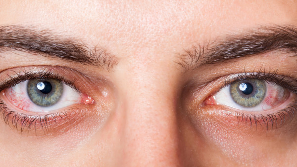 一般干眼症患者都会有哪些症状表现