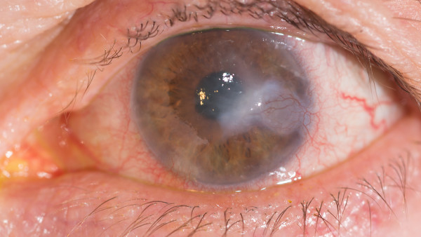 解析三种常见的治疗干眼症的方法