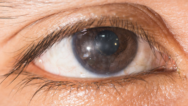 角膜炎对眼睛有哪些影响危害