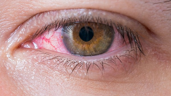 哪些是红眼病的综合症状表现