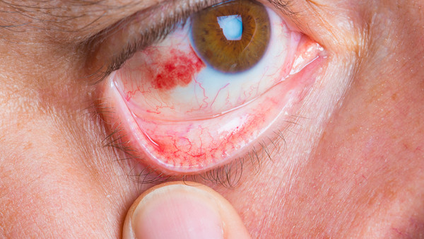 红眼病的症状特征是什么呢