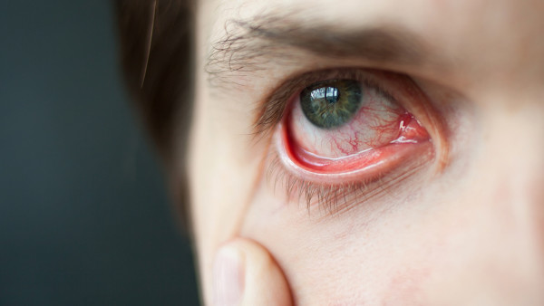 红眼病的专业诊断方法