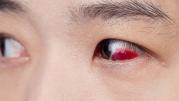 日常中避免红眼病复发的方法