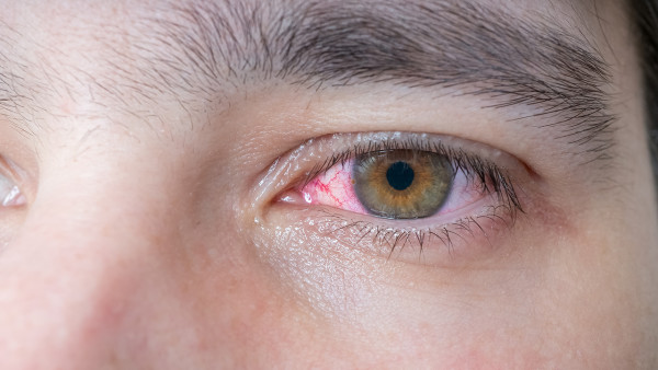 红眼病发病后的症状有哪些